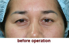 plastic-surgery-blepharoplasty